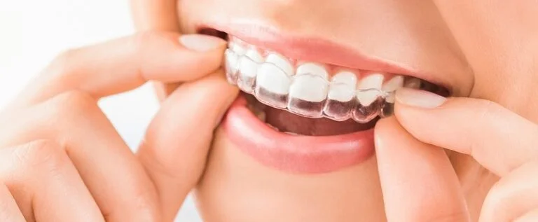 Invisalign treatment in Markdale ON