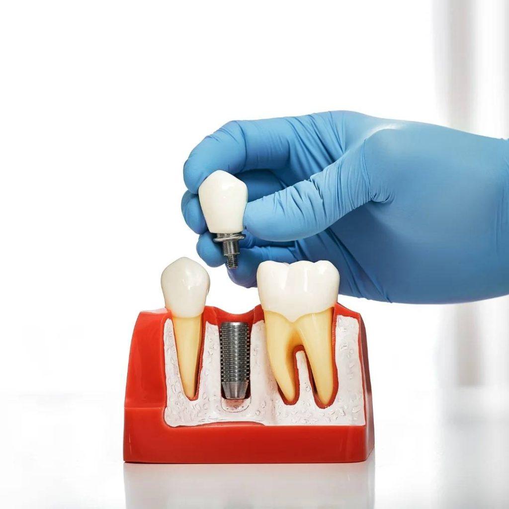 Implant Dentistry in Markdale, ON