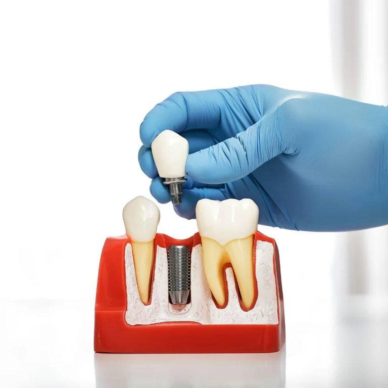 Implant Dentistry in Markdale, ON